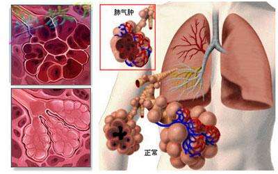 医院主页 肺气肿     前述已有《肺气肿症状有哪些特点》的概述,可